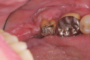 奥 の 歯茎 が 腫れる